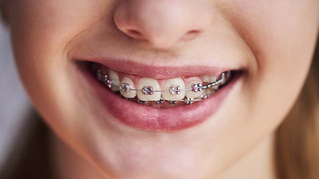 Pessoa com aparelho autoligado sorrindo