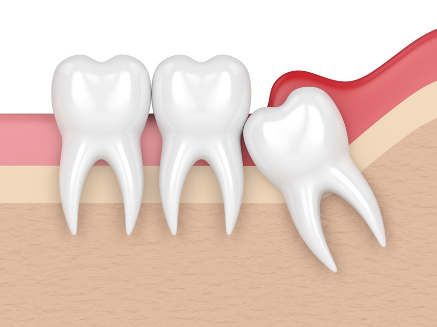 imagem ilustrativa de 3 dentes na cor branca, sendo que o dente direito está torto para a esquerda, sobre uma gengiva nas cores rosa, vermelho, bege e amarelo.