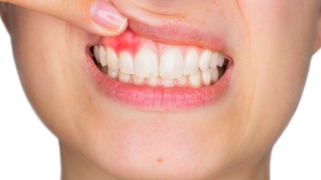 Retrato aproximado de jovem mostrando, com o dedo, gengiva superior inflamada.