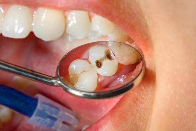 Dentista examinando a boca do paciente para saber se precisa recomendar uma pasta de dente para cárie