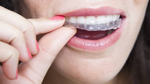 Invisalign - uma solução invisível para alinhar os seus dentes - Esmalte  Clinic